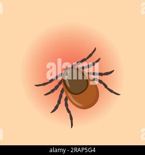 garrapata pegada en la piel humana, riesgo de infección de lyme y enfermedad transmitida por garrapatas - ilustración vectorial Ilustración del Vector