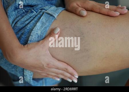 Varices dolorosas y arañas vasculares en la pierna femenina Foto de stock