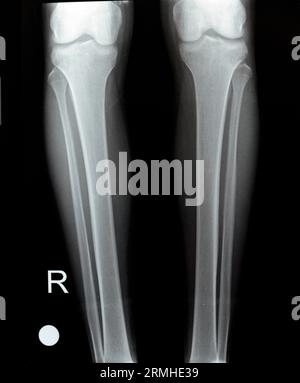 Radiografía simple de las articulaciones derecha e izquierda de la rodilla con parte inferior del fémur y partes superiores de la tibia y el peroné y la rótula que muestran una unión normal de la rodilla de A. Foto de stock