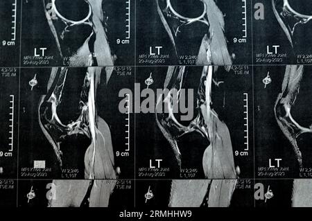 RM de la articulación de la rodilla izquierda que muestra un derrame articular mínimo, degeneración del menisco medial del cuerno posterior PHMM, esguince leve del ligamento cruzado anterior del LCA, n Foto de stock