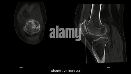 Tomografía computarizada de la articulación de la rodilla sagital y ...