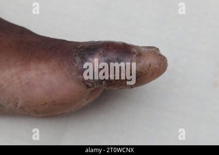 Vista aérea de la úlcera de un paciente diabético en el lado del dedo gordo del pie. Esta herida diabética está sanando lentamente Foto de stock