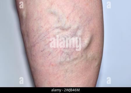 Venas hinchadas en la pierna de una mujer, primer plano de las venas varicosas. Foto de stock