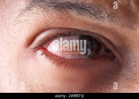 Imagen detallada de una condición ocular conocida como pterigium Foto de stock