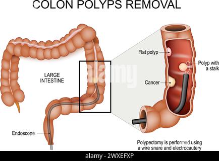 Extirpación de pólipos de colon. Colonoscopia y polipectomía. Prevención del cáncer de colon. Intestino grueso humano con endoscopio. Primer plano de una sección transversal parte de Ilustración del Vector