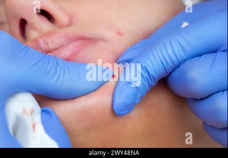 El procedimiento para limpiar la piel del acné y el acné. Esteticista presiona una espinilla en su mentón. Foto de stock