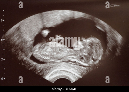 Ecografía de un feto Fotografía de stock - Alamy