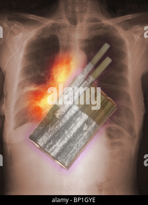 Ilustración de la radiografía de un paquete de cigarrillos superpuesta a una radiografía del tórax que muestra el cáncer de pulmón Foto de stock