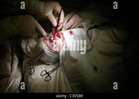 Bebé sufre la operación para reparar su labio leporino . Fue operado por el cirujano británico OLIVER Fenton. Rumania . Foto de stock