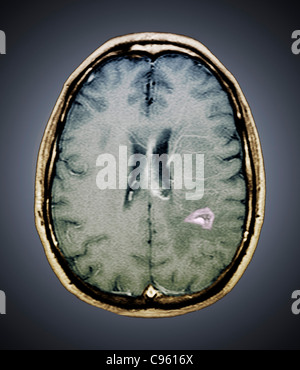 quiste en el cerebro quiste en el cerebro