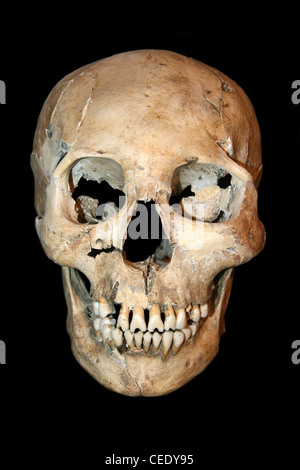 Vista frontal del cráneo humano Cranially deformada desde Costa Rica Foto de stock