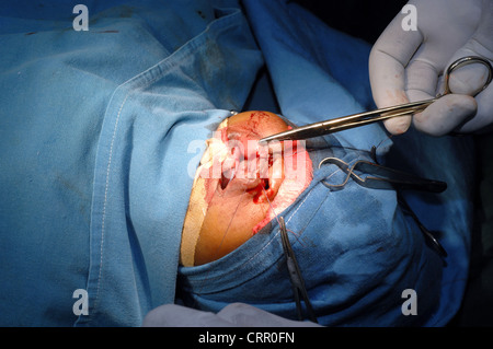 Bebé paladar hendido operación. Se coloca un segundo de sutura en el labio leporino reparado de un niño durante la cirugía Foto de stock