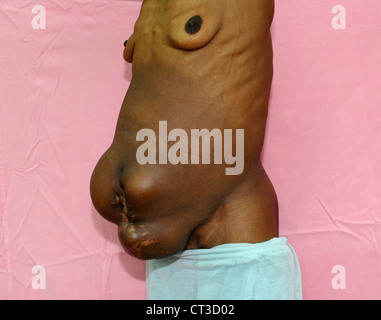 Hernia abdominal mujer fotografías e imágenes de alta resolución