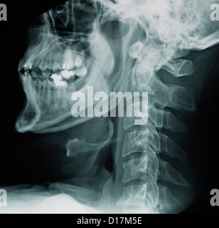 La Imagen De Rayos X De La Columna Cervical Humano Fotograf A De Stock Alamy