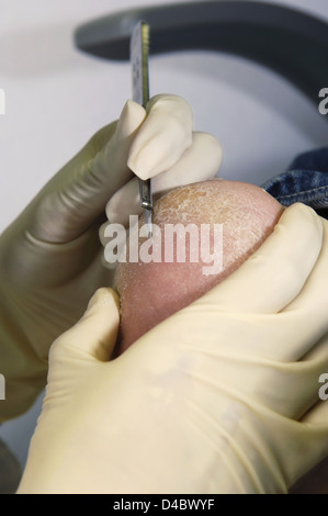 Podólogo con bisturí para quitar la piel endurecida y endurecerse desde el  pie del paciente Fotografía de stock - Alamy