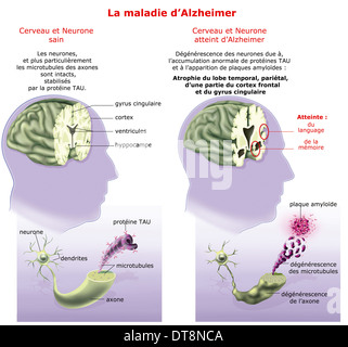 La enfermedad de Alzheimer, dibujo Foto de stock