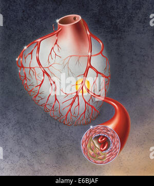 Las arterias en el corazón, mostrando la placa aterosclerótica en la arteria. Foto de stock