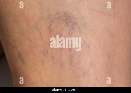 Venas agrandadas en la pierna de un paciente. Foto de stock