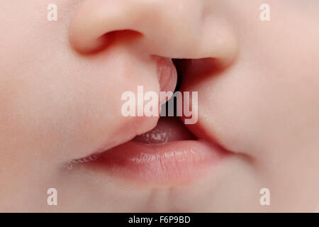 Primer plano sobre los labios del bebé con los labios y el paladar hendido. Foto de stock