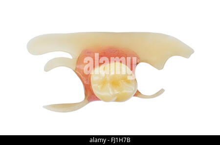 Vista superior de un solo diente falso - dentaduras artificiales - prótesis elástica Foto de stock
