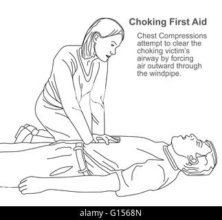 Una primera ayuda de ilustración de cómo ayudar a una persona que se está ahogando al hacer compresiones de pecho. Foto de stock