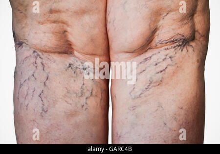 Primer plano de venas hinchadas en la parte trasera de las piernas de una mujer anciana Foto de stock