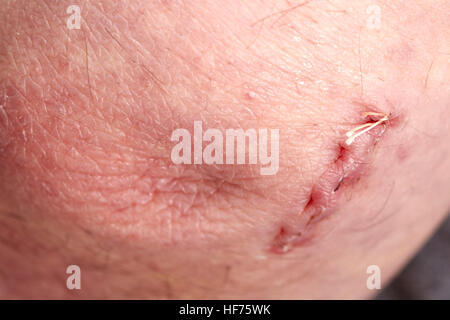 Suturas Absorbibles en el codo de la herida quirúrgica para corregir el síndrome del túnel cubital Foto de stock