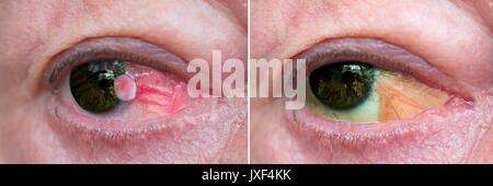 Cerca del ojo con el carcinoma de células escamosas de la conjuntiva antes y un año después surgiсal extracción. Post cirugía pseudopterygium Foto de stock