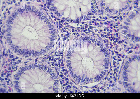 Fotografía microscópica del cáncer de colon, aumento de x400 Foto de stock