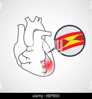 Icono de vectores de la enfermedad de la arteria coronaria ilustración Ilustración del Vector