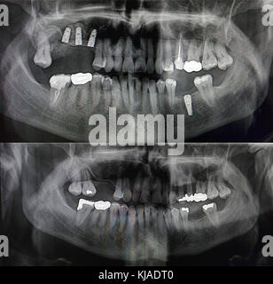 X-ray mostrando los dientes de los pacientes antes y después de la colocación de cuatro implantes dentales de metal Foto de stock