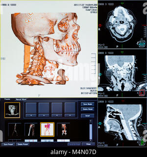 MRI (Imagen de resonancia magnética) - Tomografía computarizada de la cabeza humana en un monitor de ultrasonido. Foto de stock
