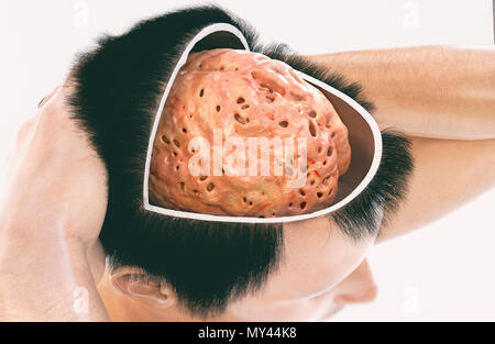 La demencia, la enfermedad de Alzheimer - Imagen 2 de 2 - 3D Rendering Foto de stock