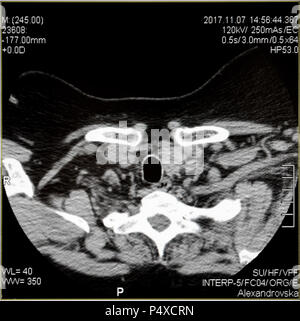 MRI (Imagen de resonancia magnética) - Tomografía computarizada de la columna vertebral en un monitor de ultrasonido. Foto de stock