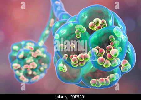 La neumonía neumocócica. Ilustración del equipo de Streptococcus pneumoniae (neumococo) las bacterias dentro de los alvéolos de los pulmones, causando neumonía. Foto de stock