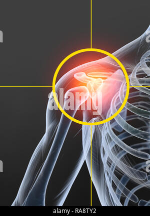 La articulación del hombro doloroso, médicamente ilustración 3D Foto de stock