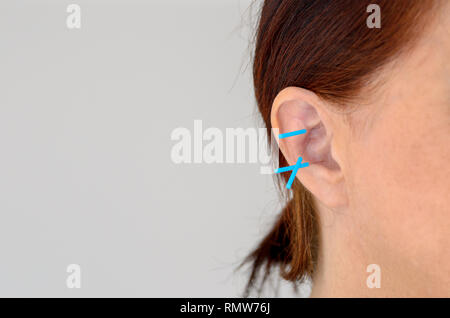 Aguja de acupuntura de oreja Fotografía de stock - Alamy