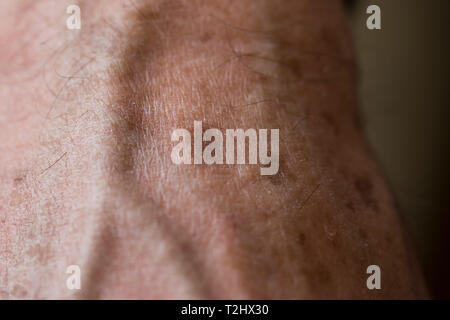 Cerca de las manchas hepáticas en la mano de un hombre mayor de edad Foto de stock