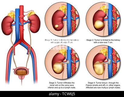 El cáncer de riñón medial Anatomía 3d ilustración vectorial aislado sobre fondo blanco. Ilustración del Vector