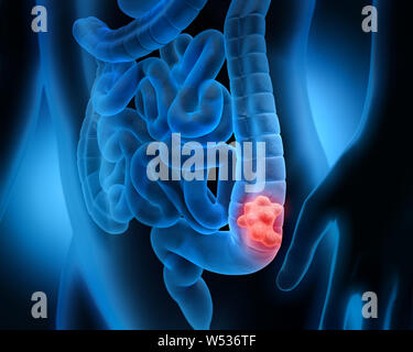 Cuerpo con pólipos intestinales - Ilustración 3D Foto de stock