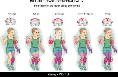 Niño con parálisis cerebral Imágenes vectoriales de stock - Alamy