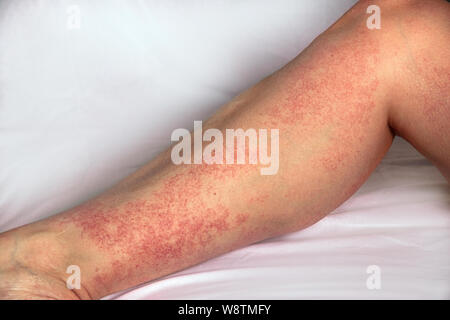 Erupciones alérgicas fuerte en la pierna. Inmunidad deficiente y reacción a los productos alérgenos. Dermatológicos erupción en la piel y el cuerpo. El problema de la HEA Foto de stock