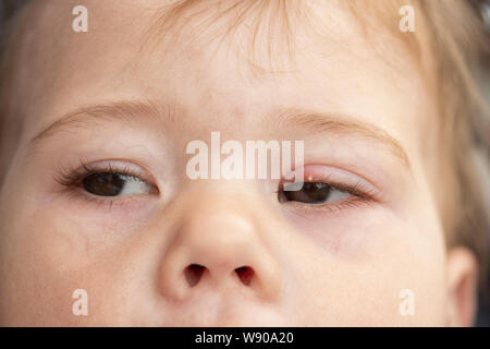 Grano Blanco En El Parpado Superior Del Ojo La Inflamacion De Los Ojos De Un Bebe Pequeno Nino Conjuntivitis Milium Es Una Pequena Dura Palida Nodulos Keratinous Fo Fotografia De Stock