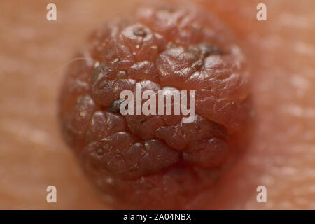 Mole sur la peau du corps. Tâche de naissance. Acrochordon. Banque D'Images