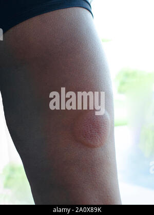 Taon insecte morsure sur une femme noire de la jambe. Premier jour. Réaction allergique. Banque D'Images