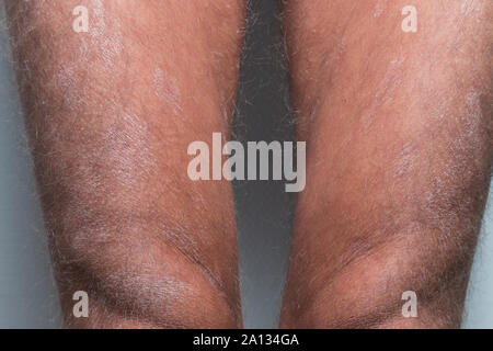 Grande plaque parapsoriasis sur caucasian man jambes Banque D'Images