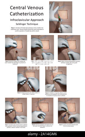 Illustration montrant le placement d'un cathéter veineux central. Banque D'Images