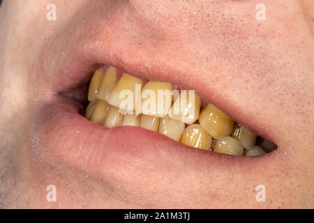 Fumeurs, la plaque sur les dents dents humaines après le tabagisme. Résineuse brun sur les dents de la plaque de près. Concept des méfaits du tabac Banque D'Images