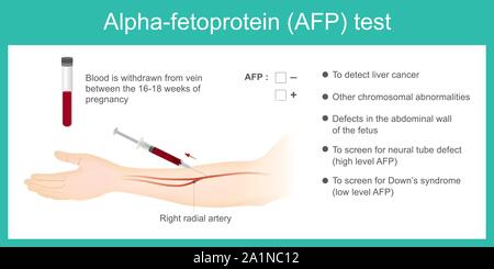 L'alpha-foetoprotéine AFP test. Utiliser l'analyse par niveau de l'AFP. de détecter le cancer du foie, et l'utilisation d'écran pour le syndrome de Down. Illustration de Vecteur
