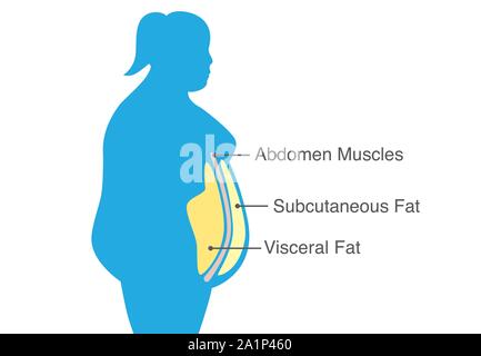 La graisse viscérale et la graisse sous-cutanée qui s'accumulent autour de tronc de femme. Illustration de Vecteur